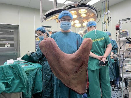 Phẫu thuật thành công cho bệnh nhân mang khối u 9 kg trên người