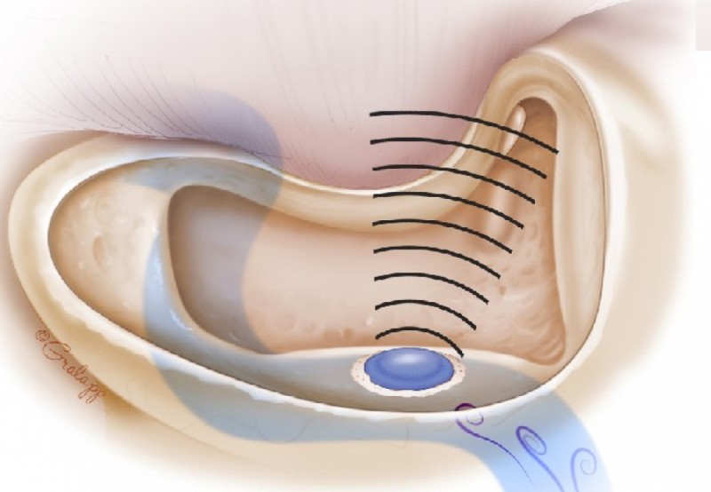 Ù tai có thể là chỉ dấu báo trước về bệnh tim mạch nguy hiểm