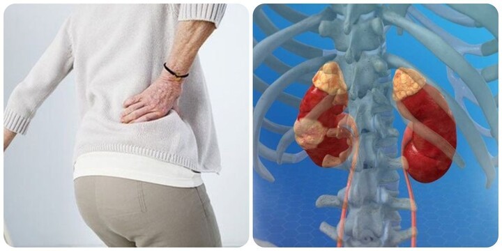 Đau lưng âm ỉ coi chừng bị ung thư thận